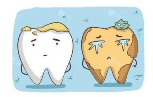 需要清洁的牙齿卡通示意图